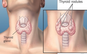 تشخیص ندول تیروئید و راه‌های درمان انواع گره‌های تیروئید